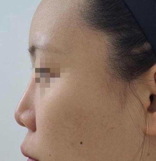 before photo: 코재수술(실리콘제거)