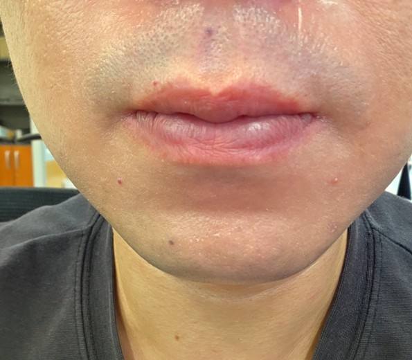 after photo: 아쿠아필링, 수염제모