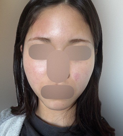 before photo: ジュベルック(Juvelook)