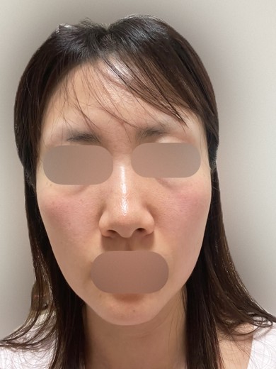 after photo: ルメッカ
