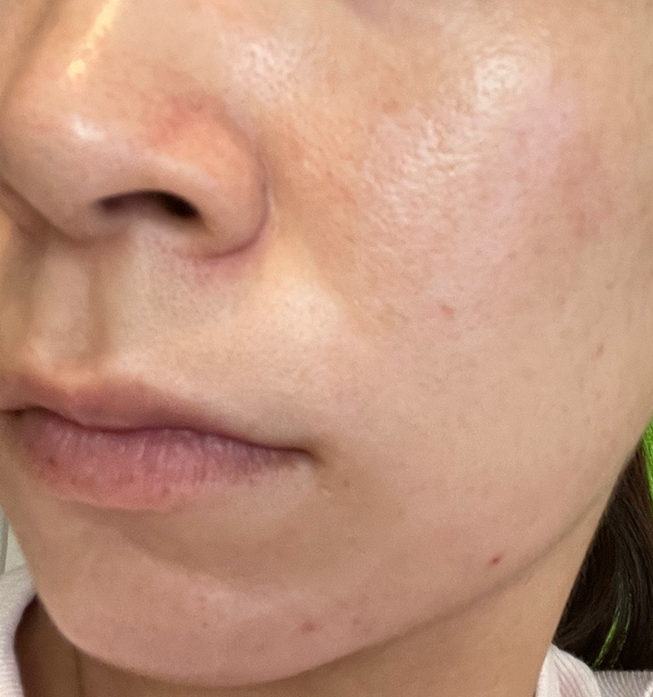 10月15日迄のご予約で初診料0円】IPL（光治療）全顔2周