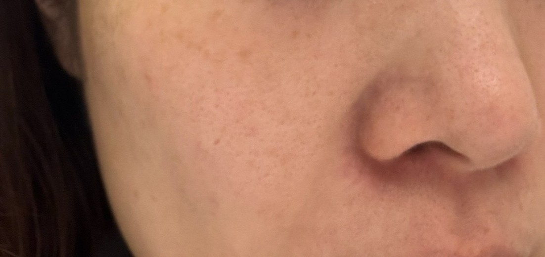 before photo: ダーマペン