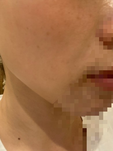 after photo: IPL(光/フォト治療), ピーリング