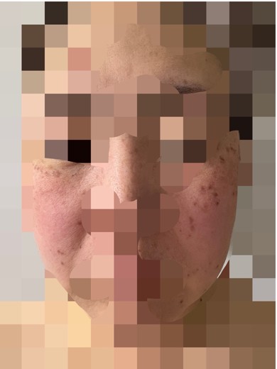 after photo: ピコスポット
