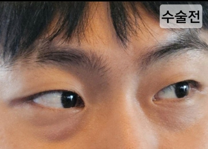 before photo: 입술필러