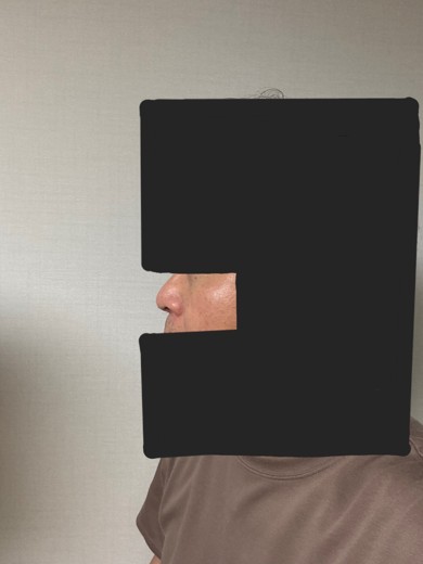 after photo: 눈밑지방재배치