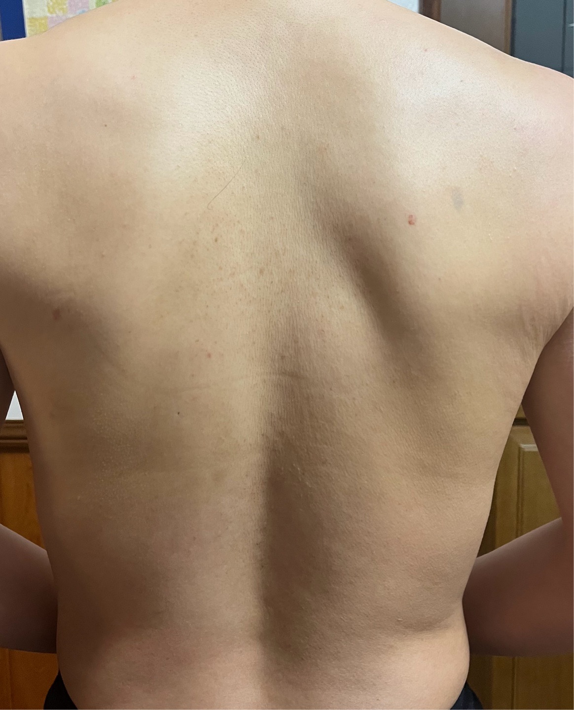 ダーマペン4（背中上 or 背中下）※麻酔代・初診料込 限定プラン有＜ニキビ跡・毛穴・凹凸・赤み＞ダーマペン4+BENEV(成長