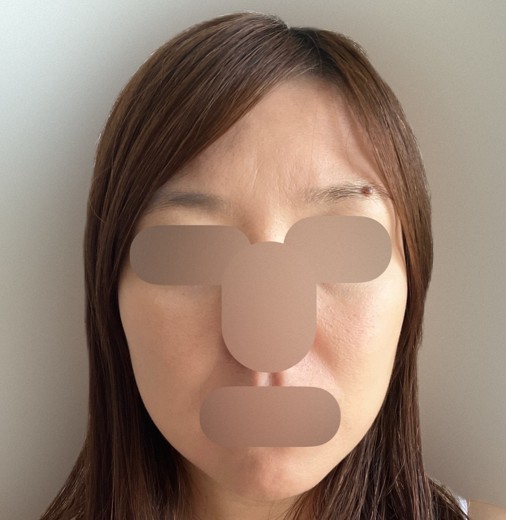 after photo: IPL(光/フォト治療)