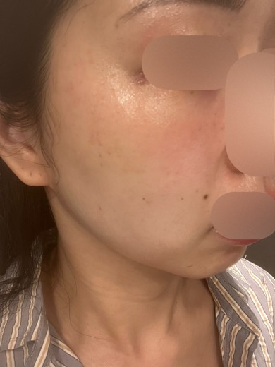 after photo: 白玉注射・点滴, ルメッカ