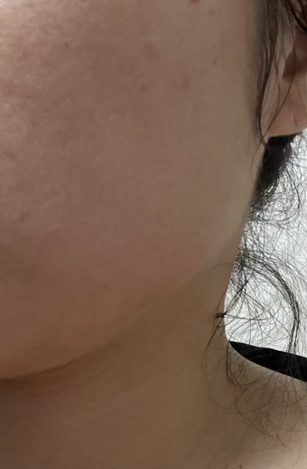 after photo: 사각턱보톡스