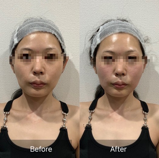 before photo: チタニウムリフト, ミラノリピール