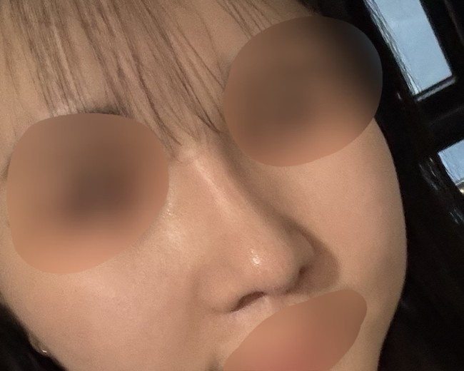 after photo: 비중격만곡증수술, 콧대(자가조직), 코끝(자가연골)