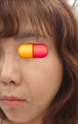 after photo: 점제거시술, V레이저