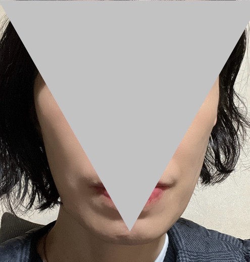 after photo: ウルトラフォーマー3(ハイフ)