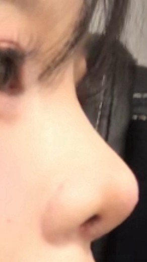 after photo: 콧대(보형물), 코끝(자가연골)