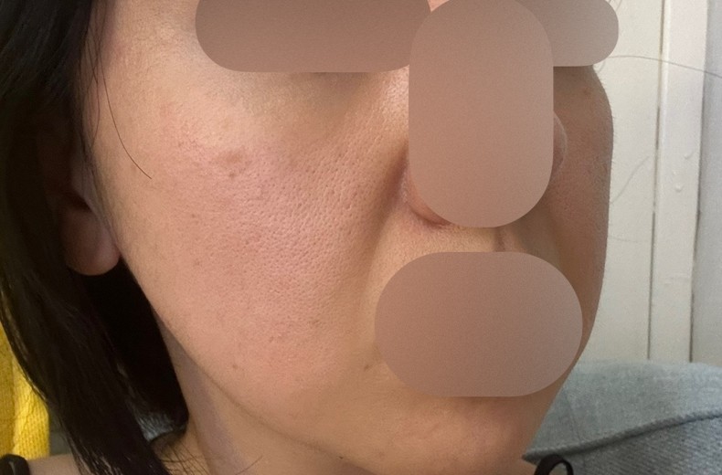 after photo: PRP피부재생술