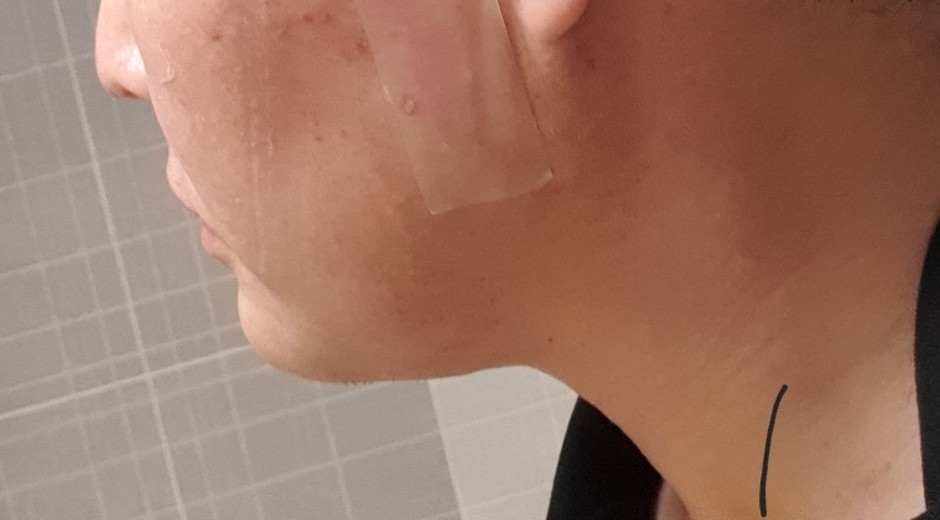 after photo: 이중턱지방흡입, 이중턱근육묶기