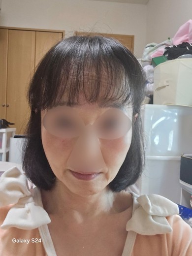 after photo: チタニウムリフト