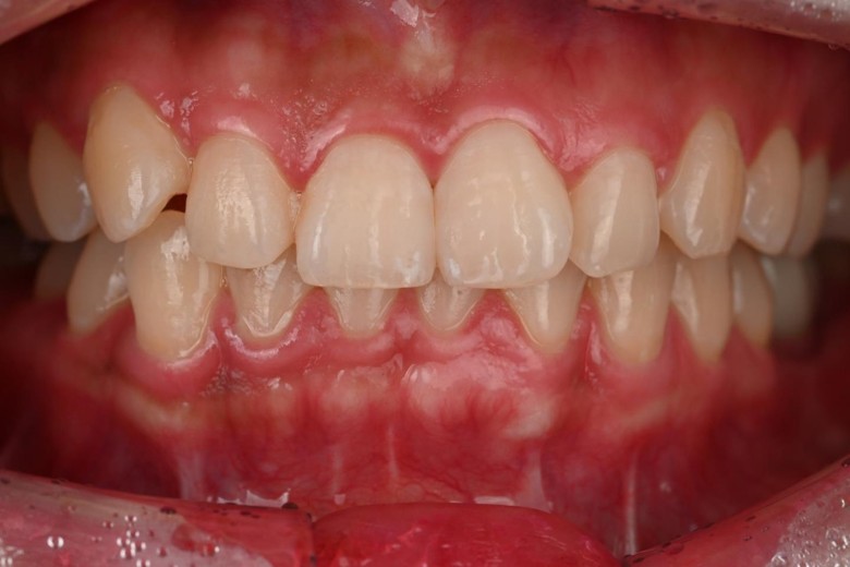 before photo: 라미네이트