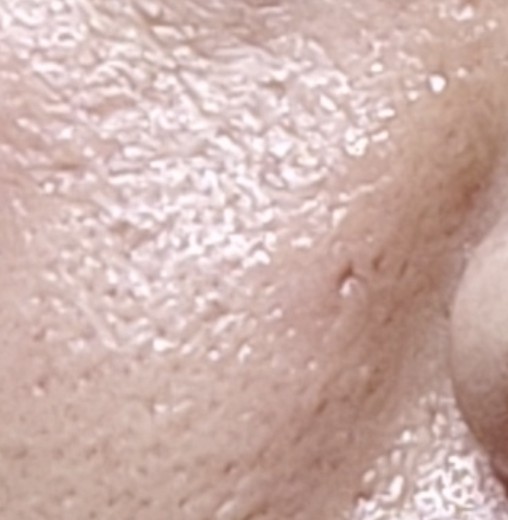before photo: ダーマペン, PRP皮膚再生療法