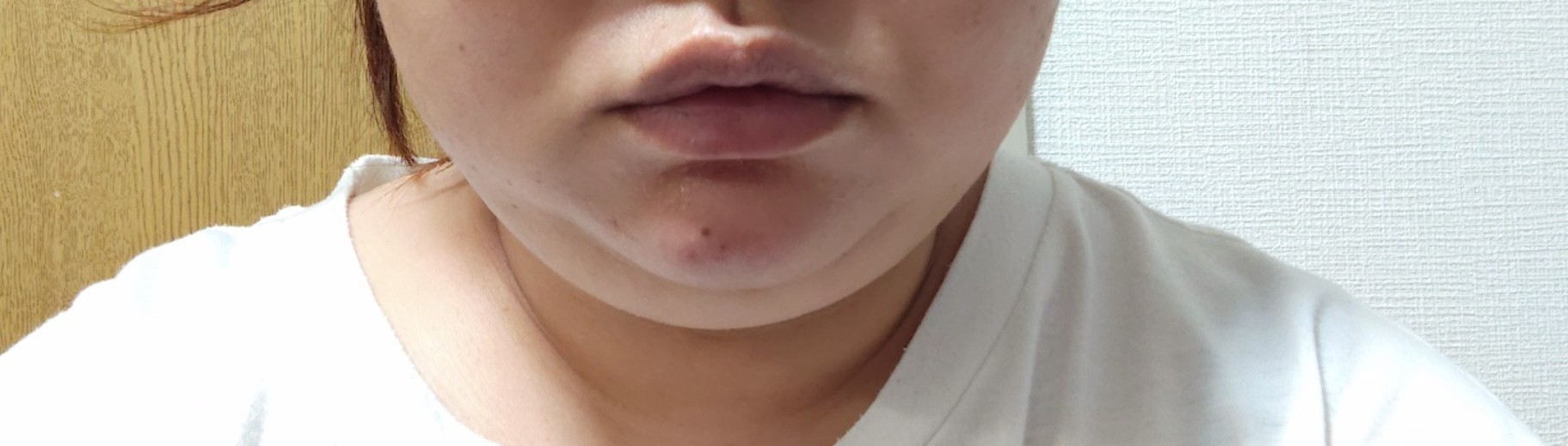 after photo: 脂肪溶解注射(顔)