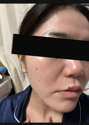 after photo: ヴェルベットスキン