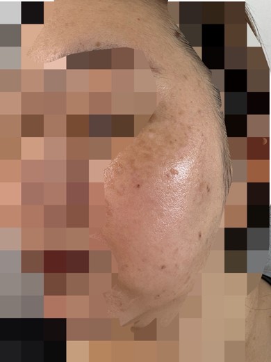 after photo: ピコスポット