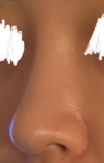 after photo: 콧대(보형물), 코끝(자가연골)