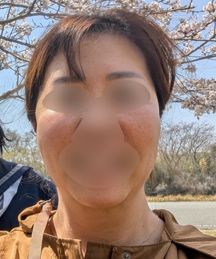 before photo: イオン導入