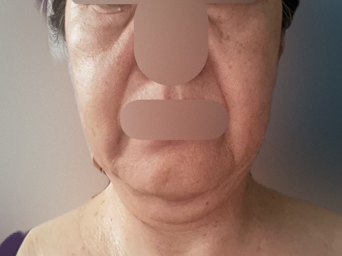 after photo: 脂肪溶解注射(顔)