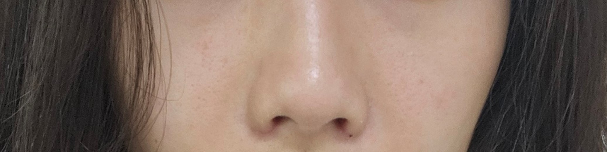 after photo: 콧볼축소