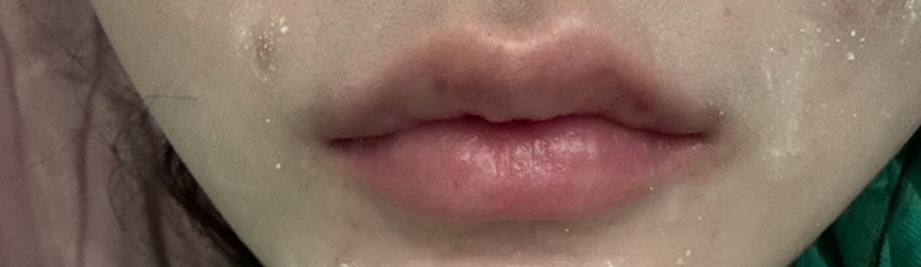 after photo: 입술필러