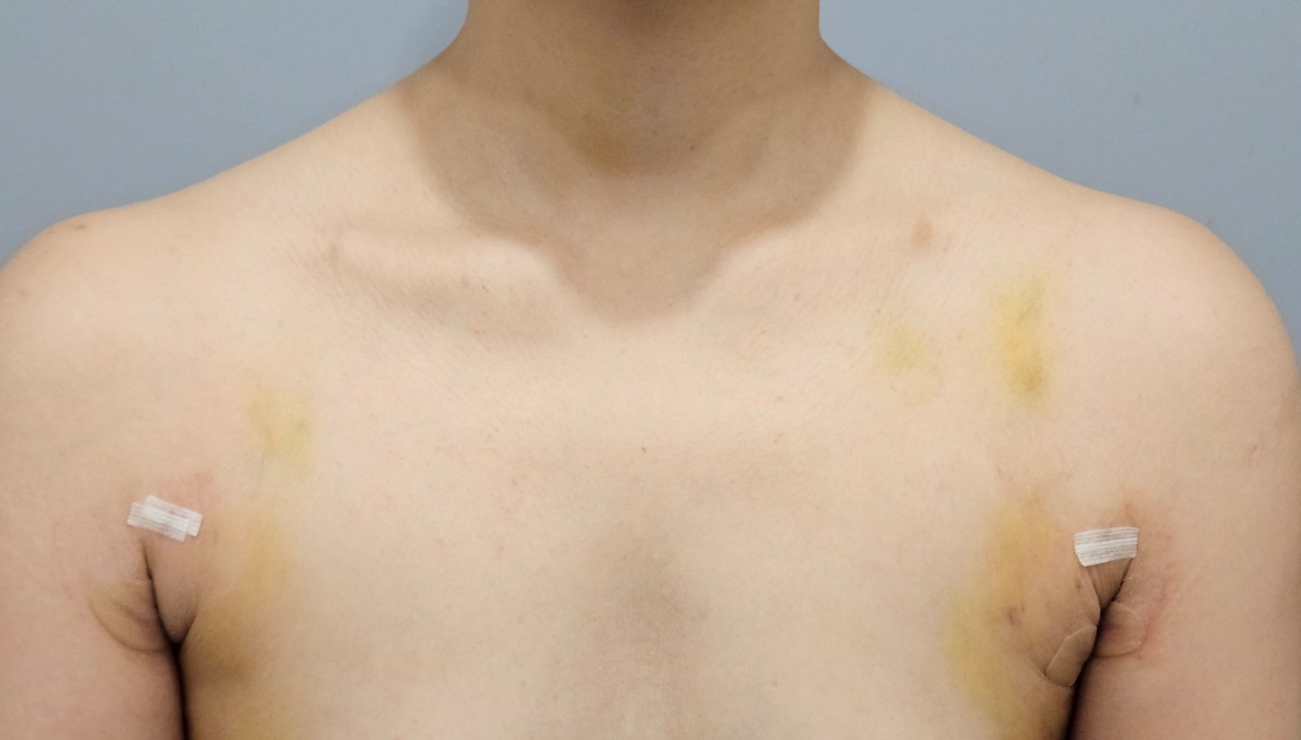 시술 전