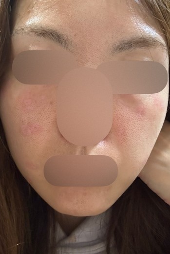 before photo: ルメッカ