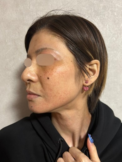 before photo: IPL(光/フォト治療), エレクトロポレーション