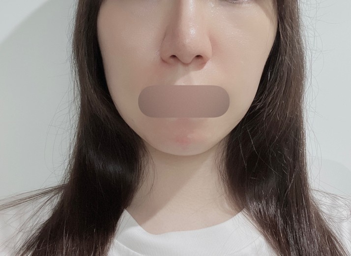 after photo: イオン導入