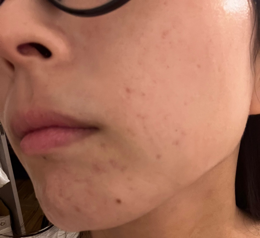 10月15日迄のご予約で初診料0円】IPL（光治療）全顔2周