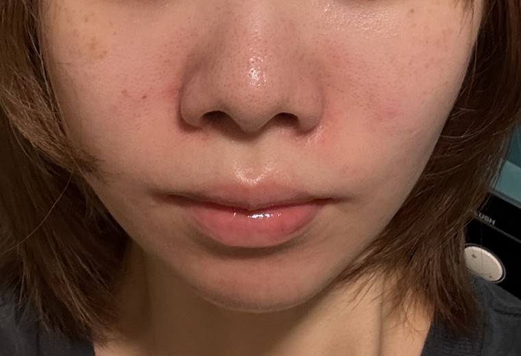 after photo: ハイドラフェイシャル