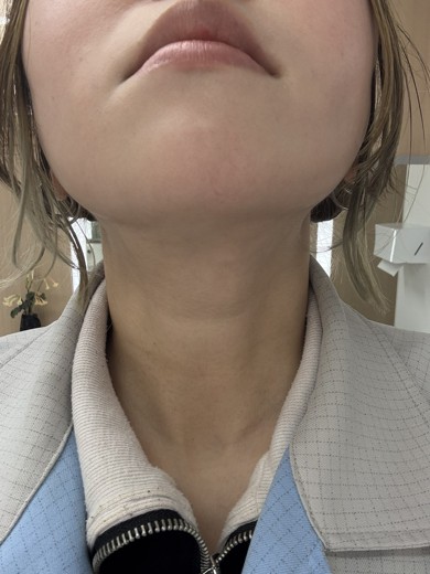 after photo: 糸リフト, 脂肪吸引(顎下), 脂肪吸引(顔), 脂肪吸引(頬)