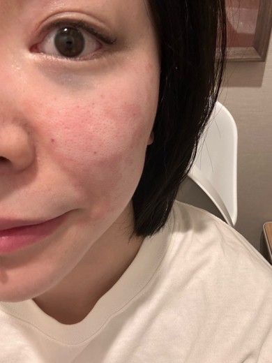 after photo: ジュベルック(Juvelook)