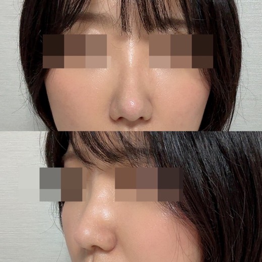 after photo: 콧볼축소