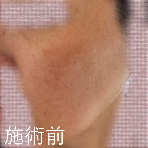 before photo: ルメッカ