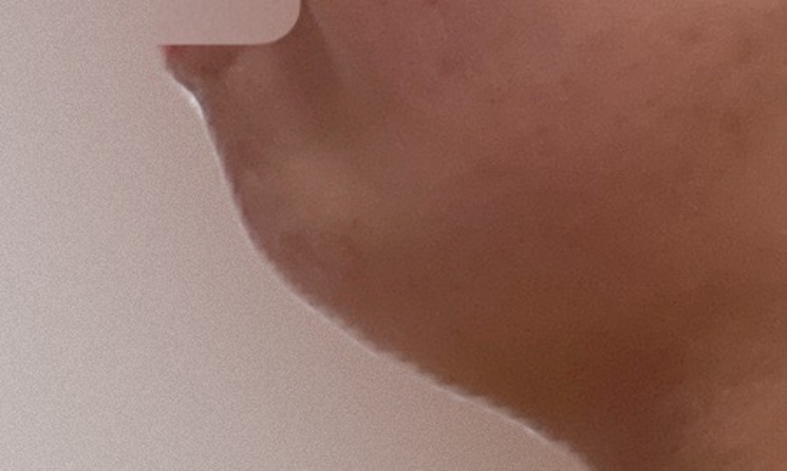 after photo: 脂肪溶解注射(顔)