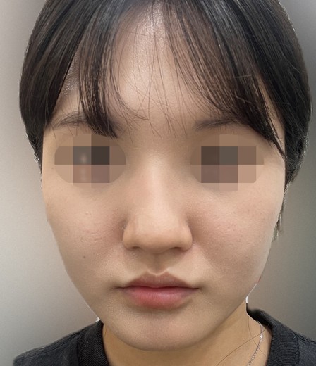 after photo: 콧볼축소