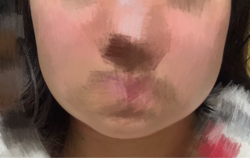 after photo: 脂肪溶解注射(顔)