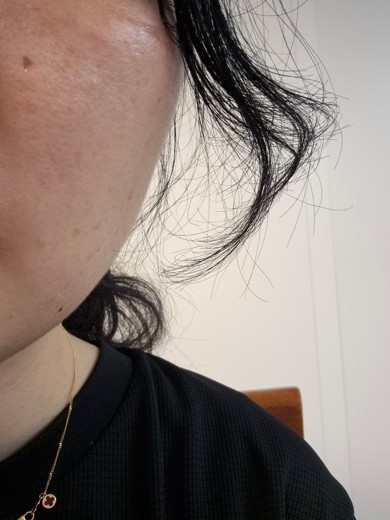 after photo: 레이저토닝