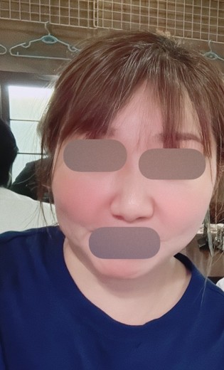 after photo: マッサージピール(コラーゲンピール)