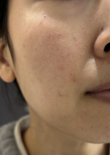 after photo: 스킨보톡스