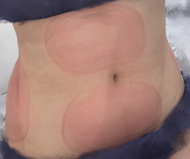 after photo: 脂肪冷却(脇腹), 脂肪冷却(腹部)