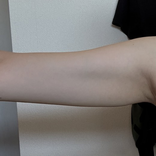 after photo: 脂肪溶解注射(腕)